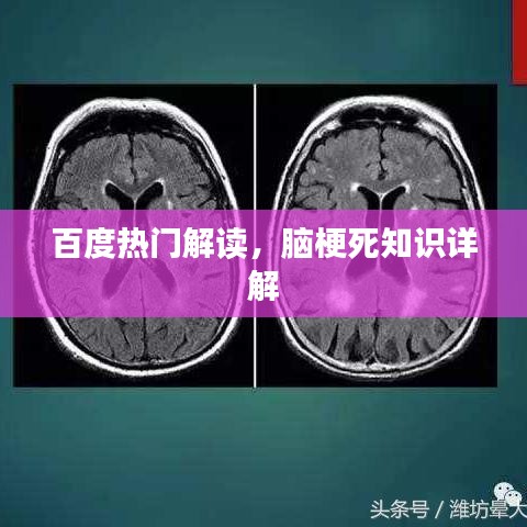 百度热门解读，脑梗死知识详解